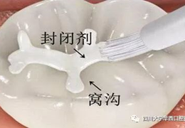 别忽视您的“二宝”，细心保护第二恒磨牙！新闻资讯