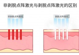 [点阵激光一年四次没效果]做点阵激光没效果？知道真相后，你可能再也不搜经验贴了