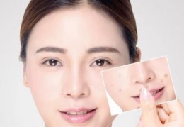 [为什么脸上抹东西疼呢]壬二酸涂在脸上刺痛，壬二酸涂了刺痛